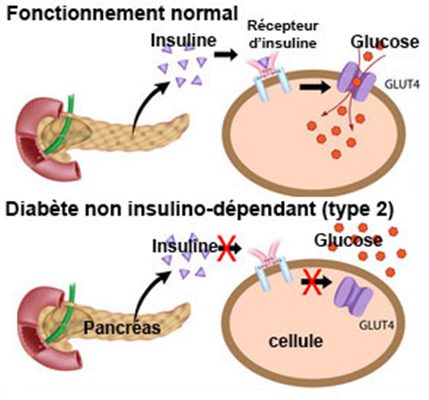 Diabète non insulino-dépendant, diabète de type 2 ou DNID