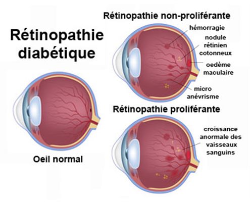 Rétinopathie