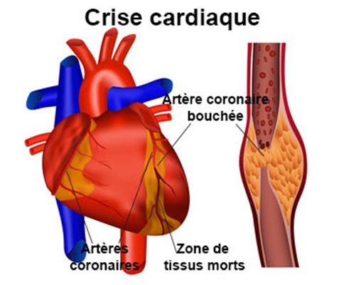 Infarctus Du Myocarde Crise Cardiaque Symptômes Traitement Définition Docteurclic Com