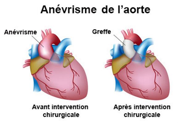 Anévrisme de l'aorte