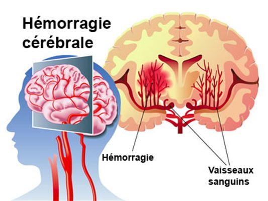 Hémorragie cérébrale