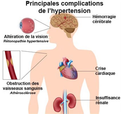 Complications de l'hypertension