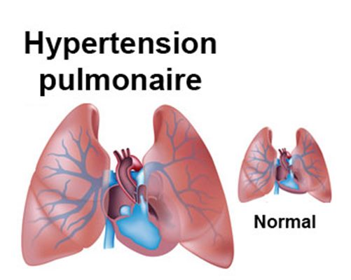 Hypertension artérielle pulmonaire