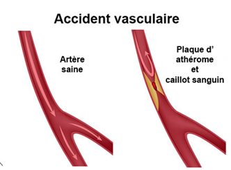 accident vasculaire
