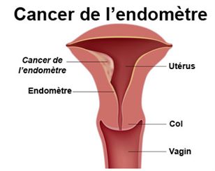 cancer de l'endomètre