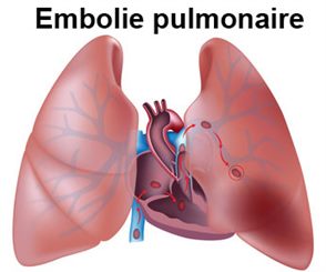 embolie pulmonaire