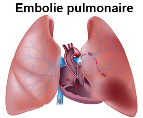 Embolie pulmonaire