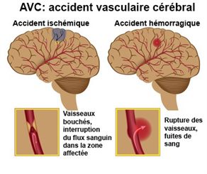 avc: accident vasculaire cérébral