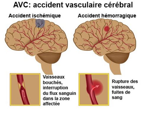 Accident vasculaire cérébral : AVC