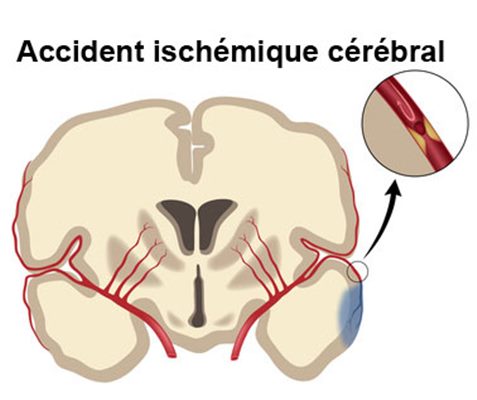 Infarctus cérébral