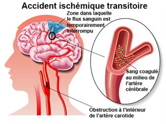 accident ischémique transitoire
