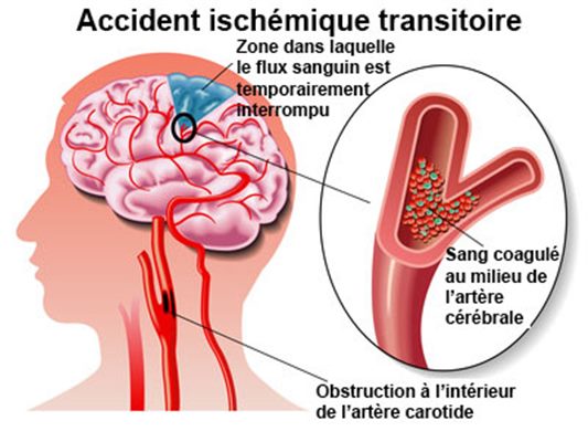 Accident ischémique transitoire