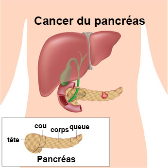 Tumeur du pancréas : symptômes, traitement, définition ...