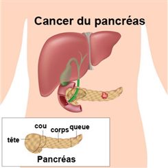 cancer du pancréas