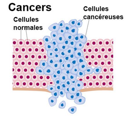 cancer cellule maligne anemie 3 mois grossesse