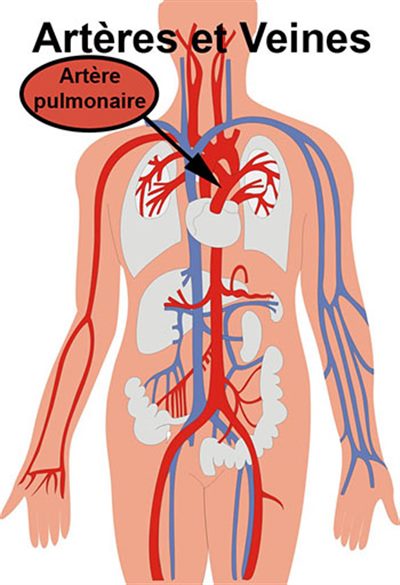 Infarctus pulmonaire