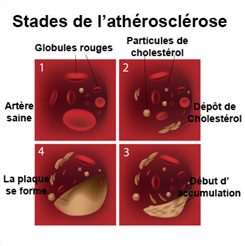les stades de l'athérosclérose