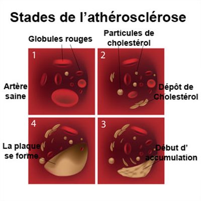 Athérosclérose : des réponses à vos questions