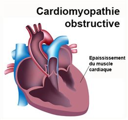 cardiomyopathie obstructive