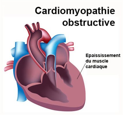 Cardiomyopathie obstructive