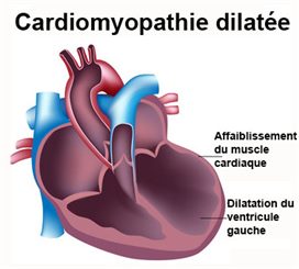 cardiomyopathie dilatée