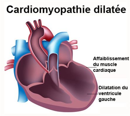 Cardiomyopathie dilatée