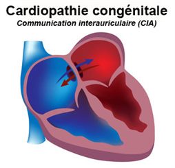 communication interauriculaire (cia)