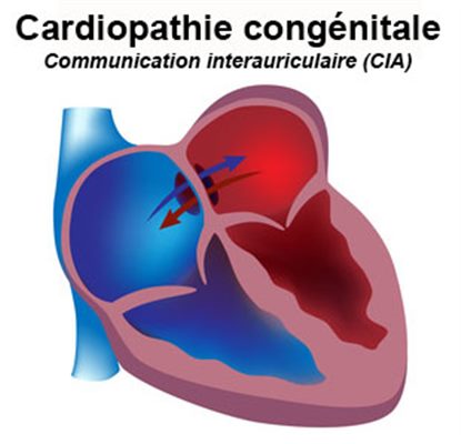 Cardiopathies congénitales