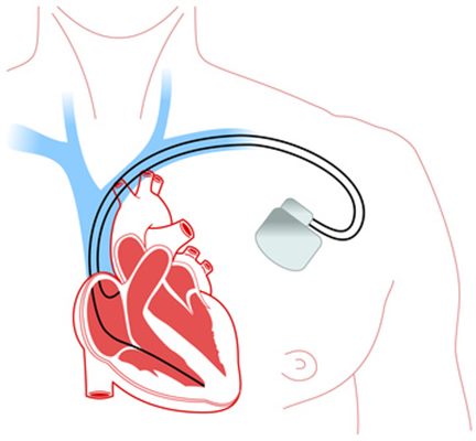 Innovations des stimulateurs cardiaques