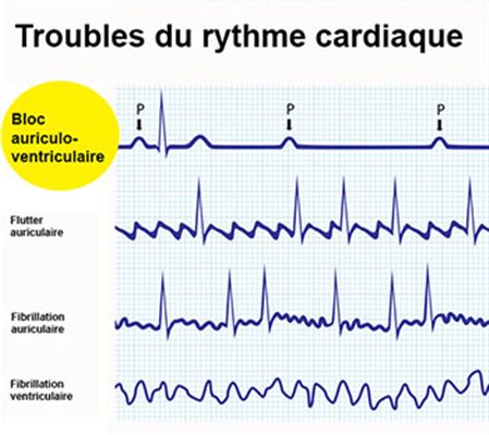 Bloc auriculo-ventriculaire