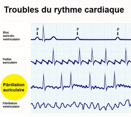 Arythmie complète par fibrillation auriculaire