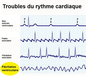 fibrillation ventriculaire