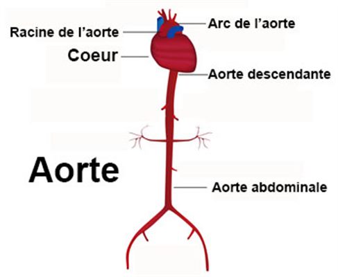 Coarctation de l'aorte