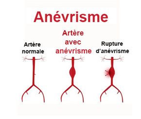 anévrysme