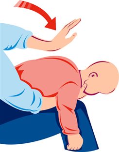 manoeuvre de mofenson