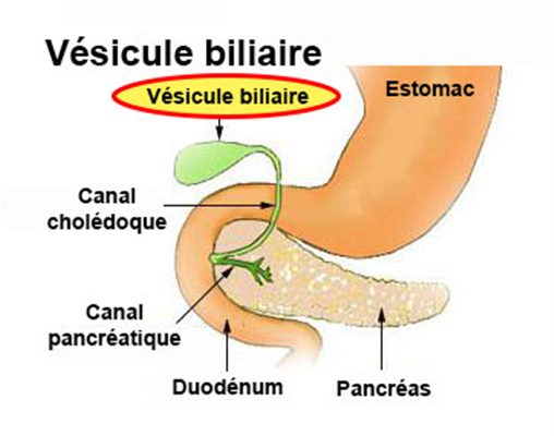 Cholécystite