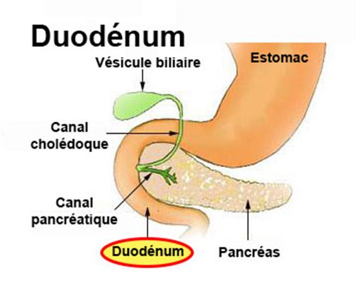 Cancer du duodénum