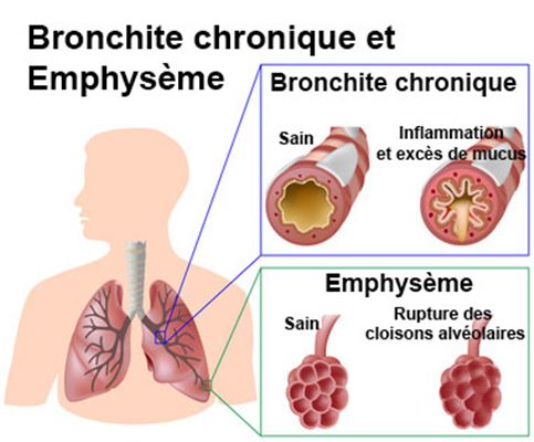 BPCO : Bronchopneumopathie chronique obstructive