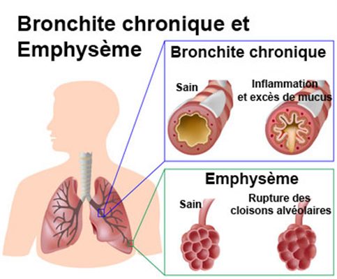 Traitement de la BPCO