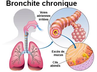 bronchite chronique