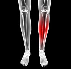 fracture de la jambe