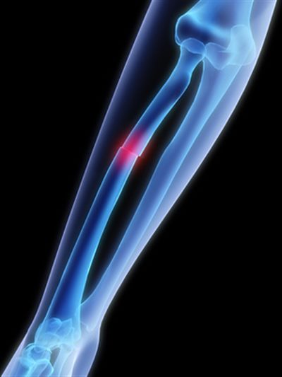 Fracture de l'avant-bras : symptômes, traitement, définition