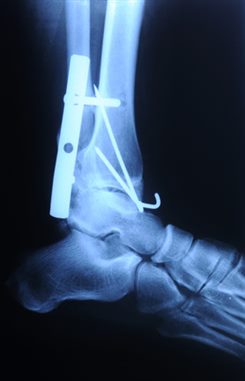 fracture de la cheville