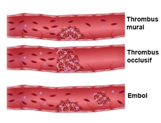 thrombus et embol