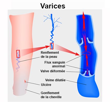 Varices jambes traitement