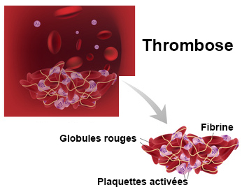 Thrombose grossesse symptomes