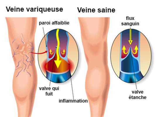 Maladie veineuse