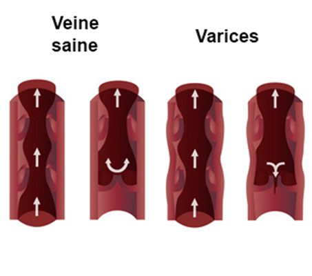 varices, vulvaires : symptômes, traitement, définition ...