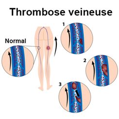thrombose veineuse