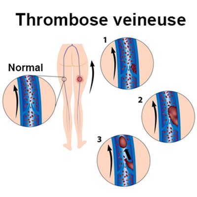 Thrombose veineuse